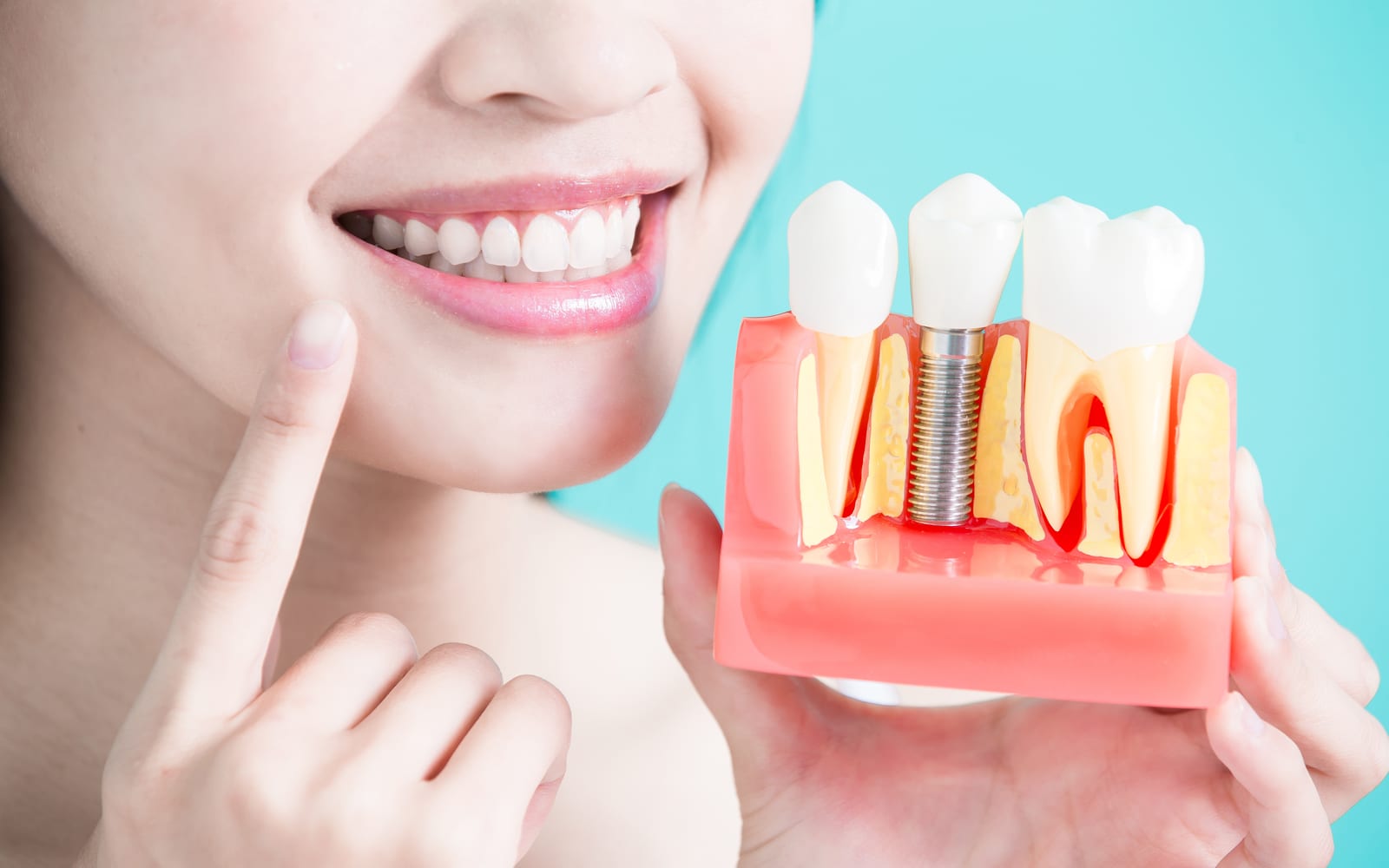 Smiling woman holding dental implant model