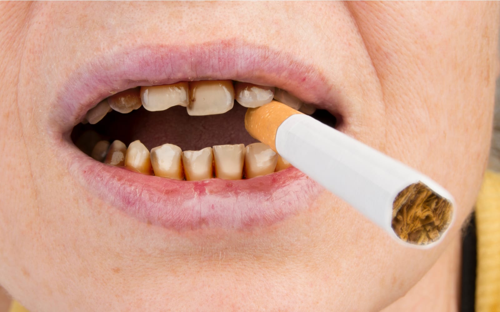 Teeth damaged by smoking