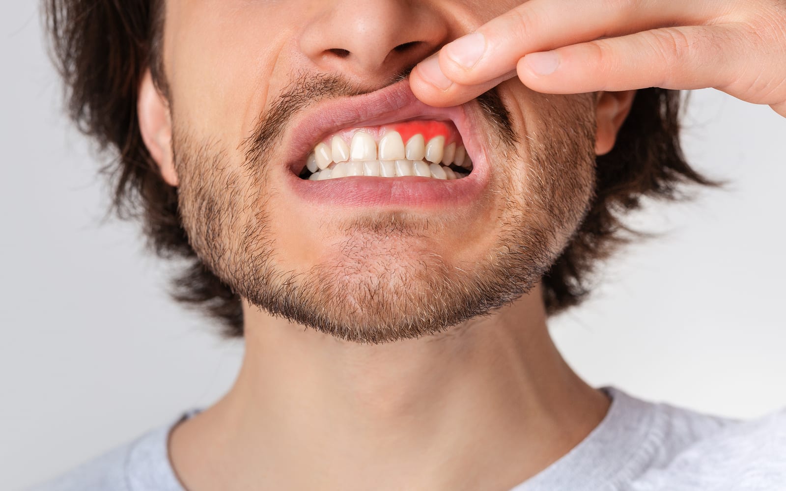 Man pulling up a lip to reveal gingivitis