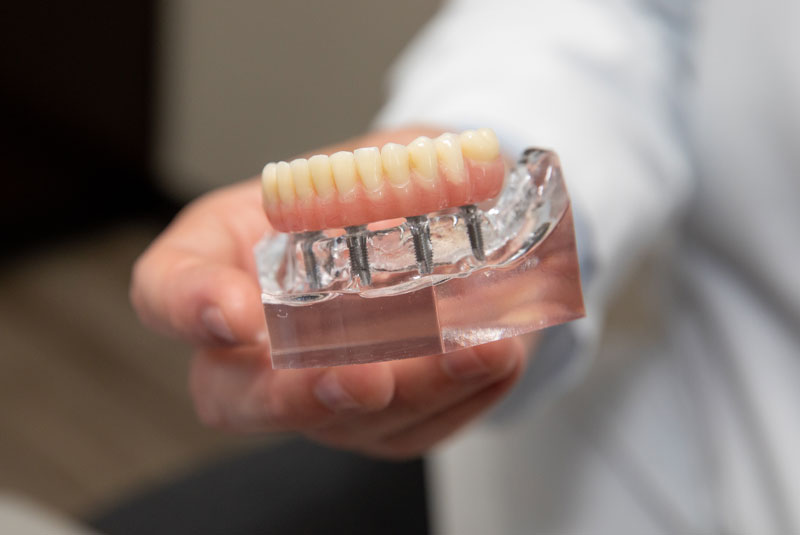 full arch implant model being held by dentist