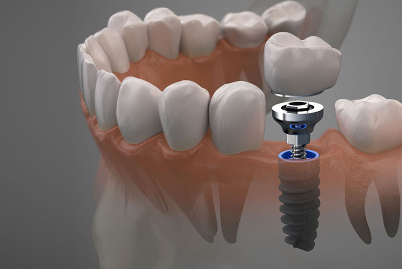 dental implant 3d model of 3 components