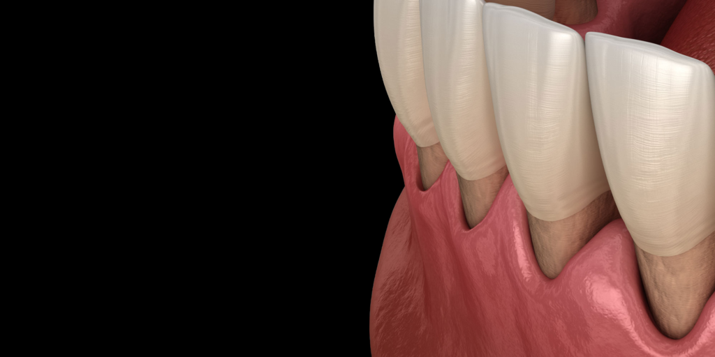 gum grafting model