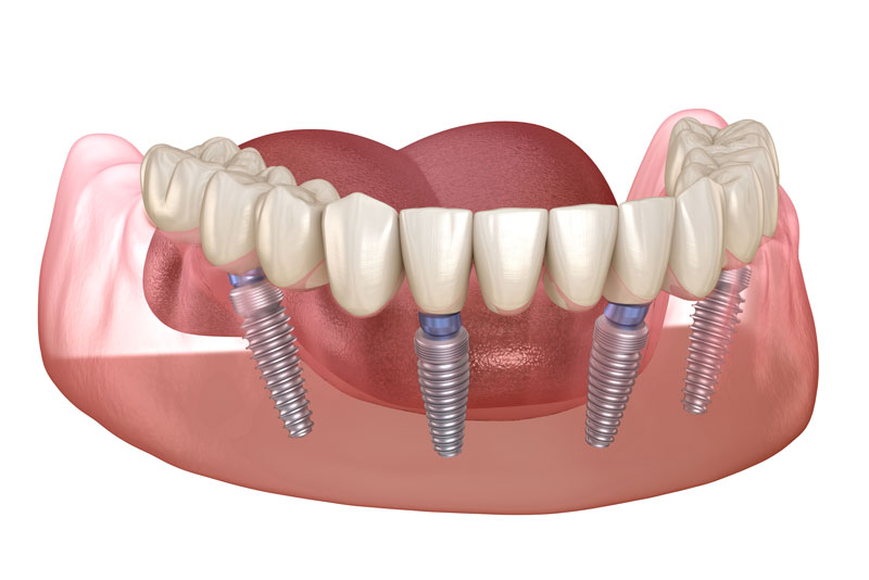 an all-on-4 dental implant model showing the implant posts below the dental crowns