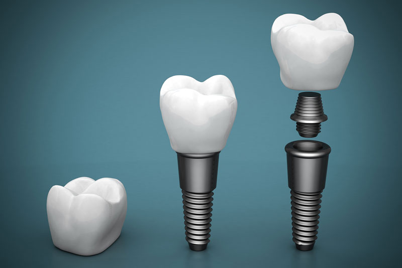 Image of the steps it takes to have a full dental implant, with the dental crown, abutment, and post.